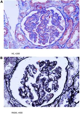 Rare cause of coronary artery ectasia in children: A case report of methylmalonic acidemia with hyperhomocysteinemia